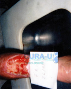 ulcera-traumatica-002