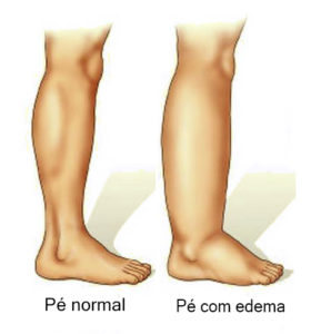linfedema