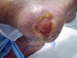 tratamento-avancado-de-feridas-3