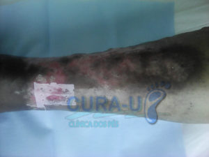 ulcera-vascular-depois-2