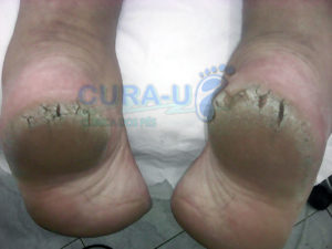 Antes