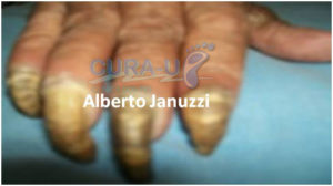 Antes