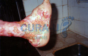 pe-de-charcot-001