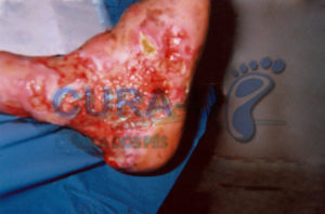 pe-de-charcot-002