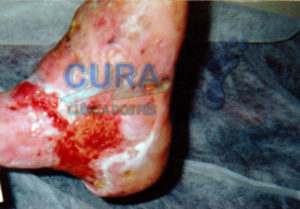 pe-de-charcot-003