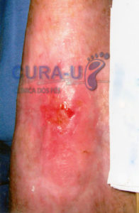 ulcera-traumatica-004